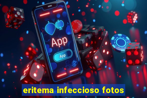 eritema infeccioso fotos
